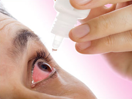 Điều trị viêm kết mạc (đau mắt đỏ)