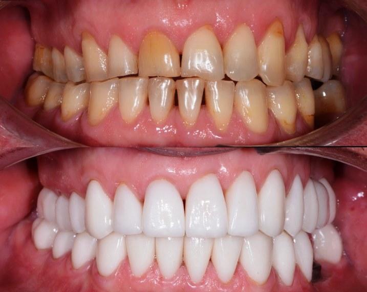 Білі зуби після реставрації в клініці Лукашука | Фото 4