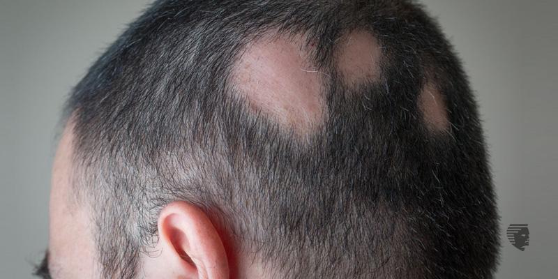 Cicatricial Alopecia - Types, Symptoms, Causes & Treatment - AHS India