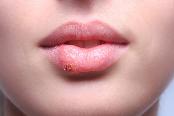 Cold Sore Treatment Fast