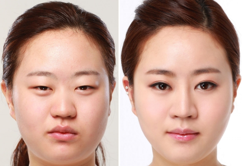 Cắt mắt 2 mí vĩnh viễn không? Là câu hỏi được nhiều khắc hàng đặt ra khi đến tư vấn tại Thẩm Mỹ Việt Nam