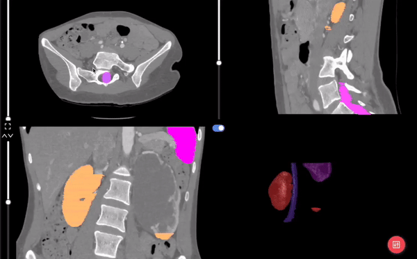 Medical Image Segmentation of an Abdomen CT Scan