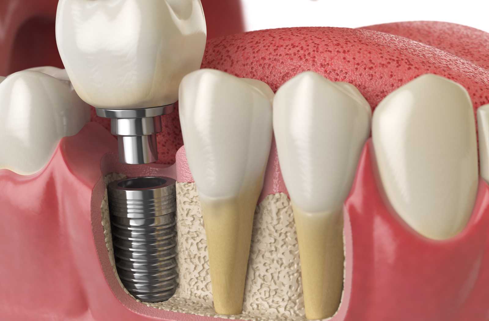 illustration of how much bone foundation a successful dental implant needs