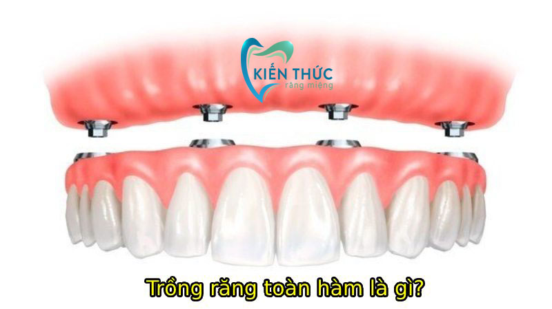 Trồng răng Implant toàn hàm giúp khôi phục chức năng ăn nhai và mang lại thẩm mỹ cao