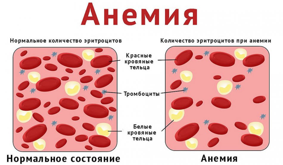 Признаки анемии у взрослых мужчин