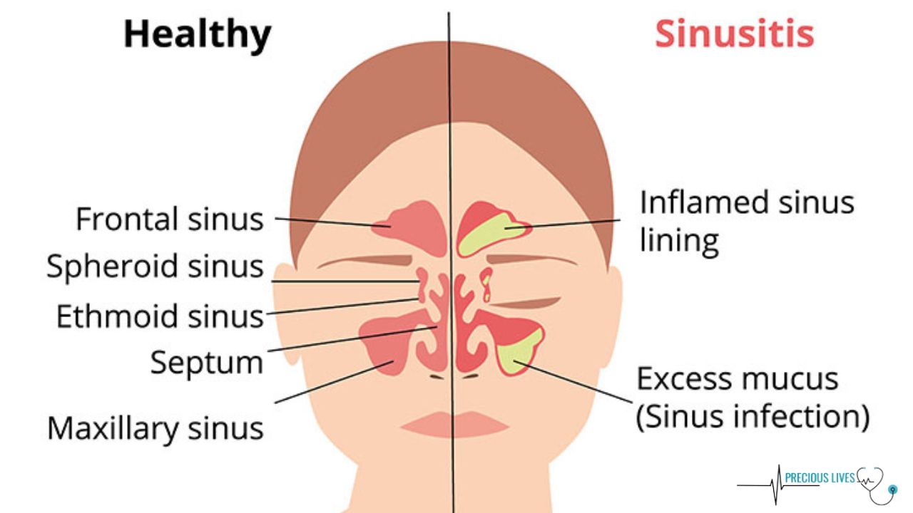 Online Doctor for Sinus Infection in New York 