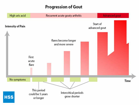 The progression of gout over time according to Dr. Theodore R. Fields, MD, FACP