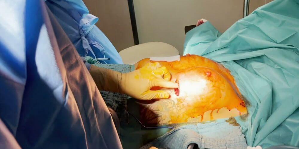 Une femme est allongée sur une table d'opération, endormie sous anesthésie générale, pendant une chirurgie d'augmentation mammaire.
