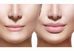 Image result for Lip dermal filler