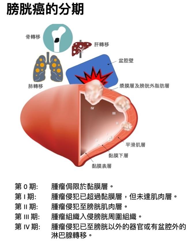 健康揭泌-泌尿-膀胱癌