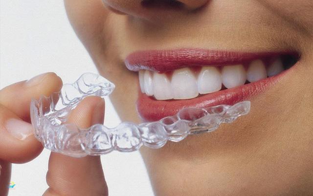 Niềng răng trong suốt: 3 vấn lưu ý không thể bỏ qua