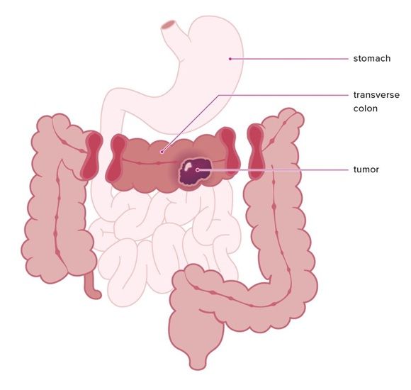 Crohn's Disease