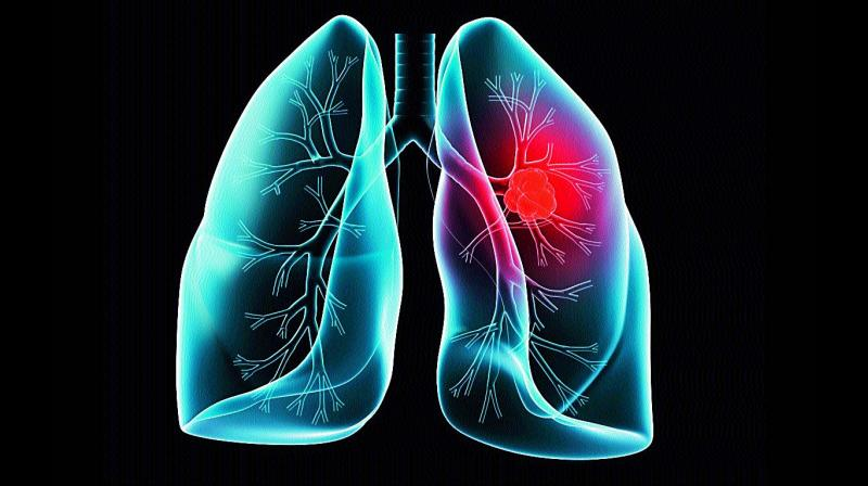 lung cancer

