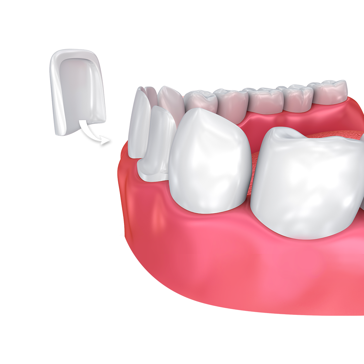 Dental veneers can improve your smile immediately. 