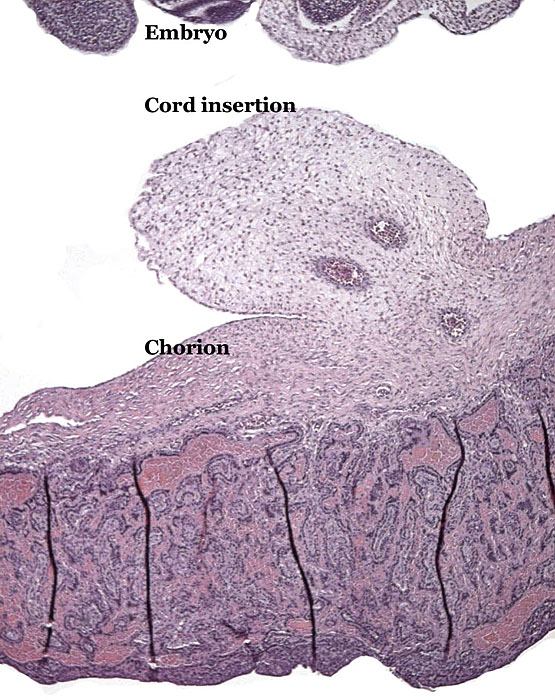 Placental surface with insertion site of the umbilical cord.