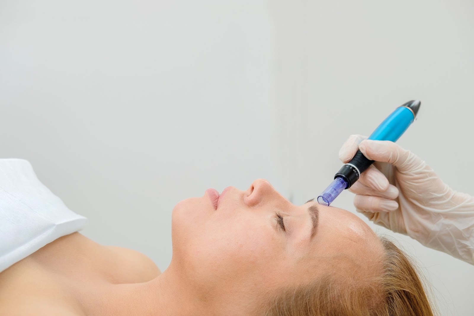 Microneedling for Hyperpigmentation and Dark Spots