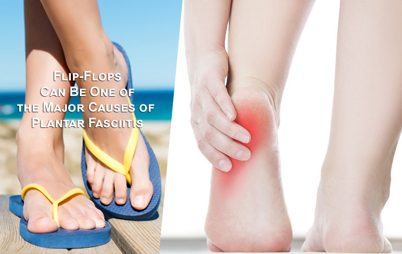 Sarkantyú és saroktáji fájdalom egyik gyakori oka a nyári flip flop papucsok viselése.