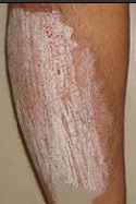 Itching key symptom of psoriasis