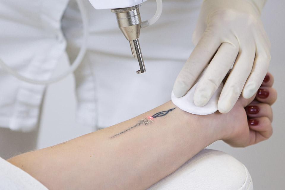 Westend Laser Clinic Aberdeen | Laser Tattoo Removal Aberdeen