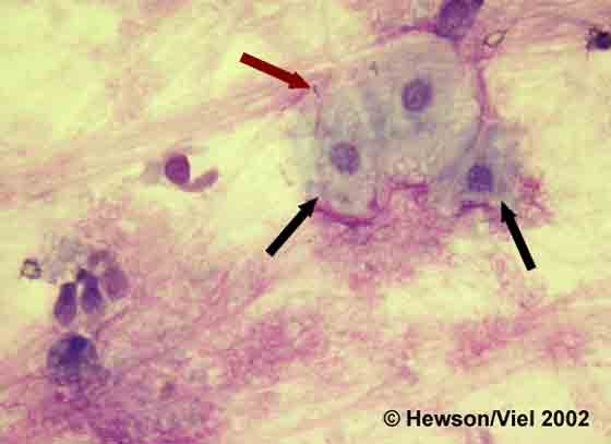Squamous epithelial cells (black arrows) with attached rod-shaped bacteria (red arrow) occasionally observed in the BAL. Wright-Giemsa stain. Magnification: 1000X.