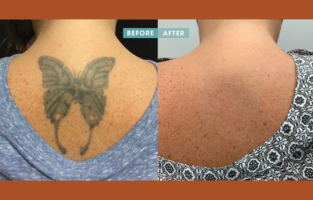 How Safe is Laser Tattoo Removal Really  By Dr Jolly Shah