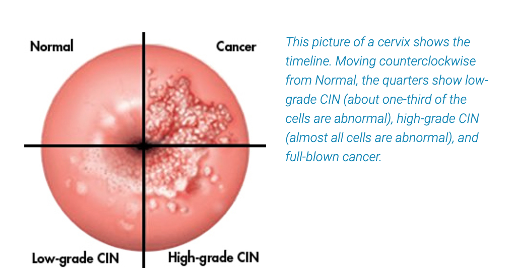 cervical cancer patient journey