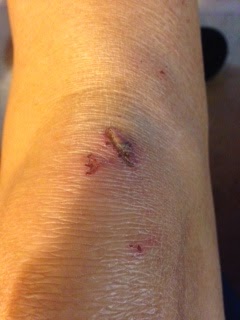 Knee healing after 48 hours 3 25 15_0755.JPG
