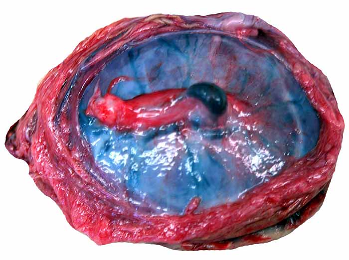 Fetal surface of term placenta with centrally inserted umbilical cord of term gestation after Cesarean section.