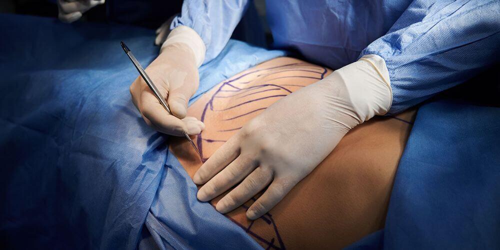 une femme allongée sur une table de chirurgie avec des marques sur son ventre et ses cuisses