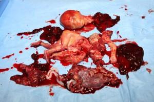 Abortion-20-weeks-300x199