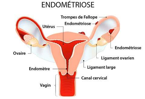 Endométriose : symptômes, diagnotic, traitements et risques d'infertilité