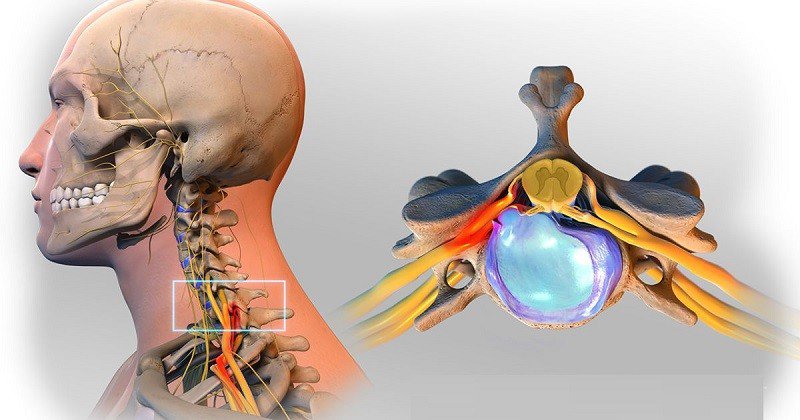 Thoát vị đĩa đệm cột sống cổ