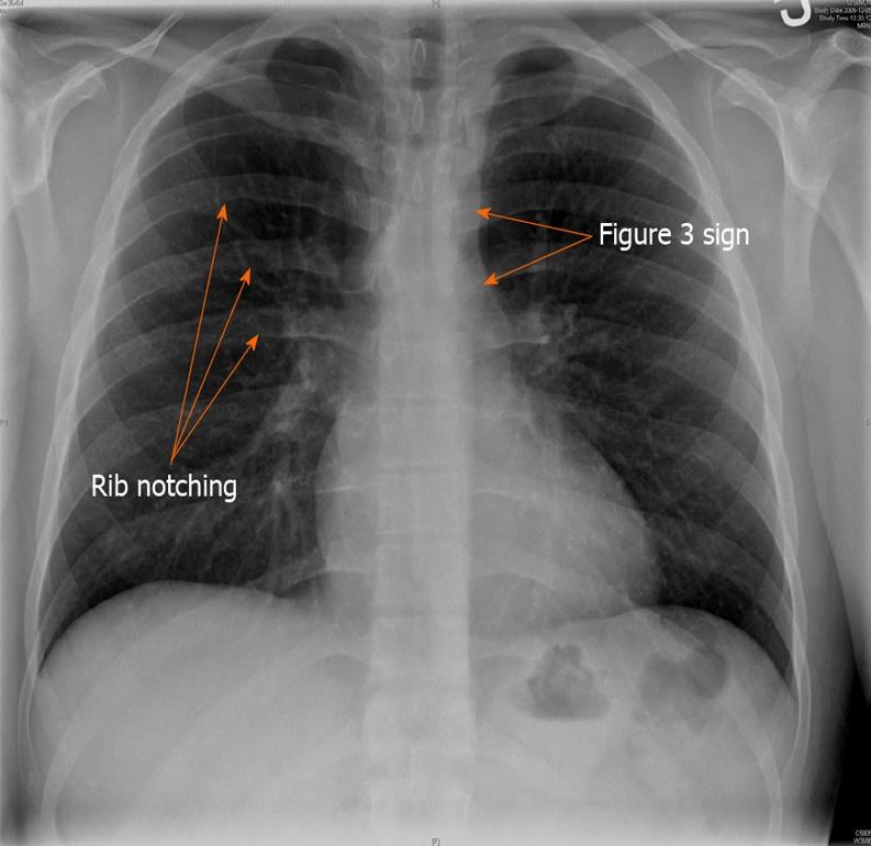 Management of adults with coarctation of aorta