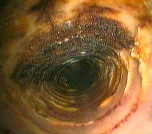 Necrosis de la membrana mucosa traqueal después de intubación endotraqueal.