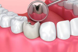 Kiểm tra răng sứ định kỳ
