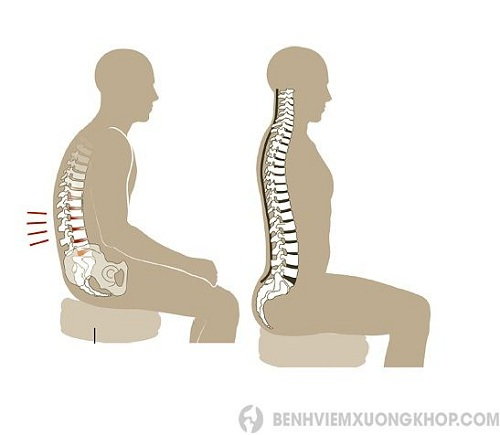  cải thiện tình trạng thoát vị đĩa đệm