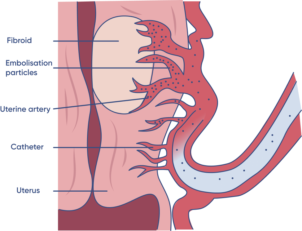 Fibroids