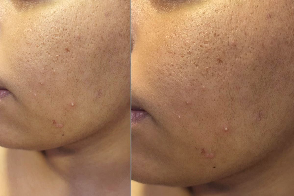 Tiny Pores Big Impact Your Skins Story