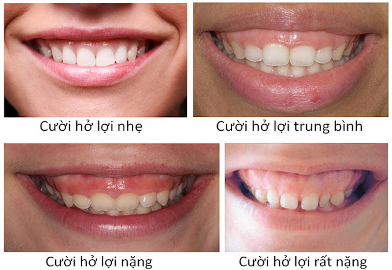 Cười hở lợi là gì?