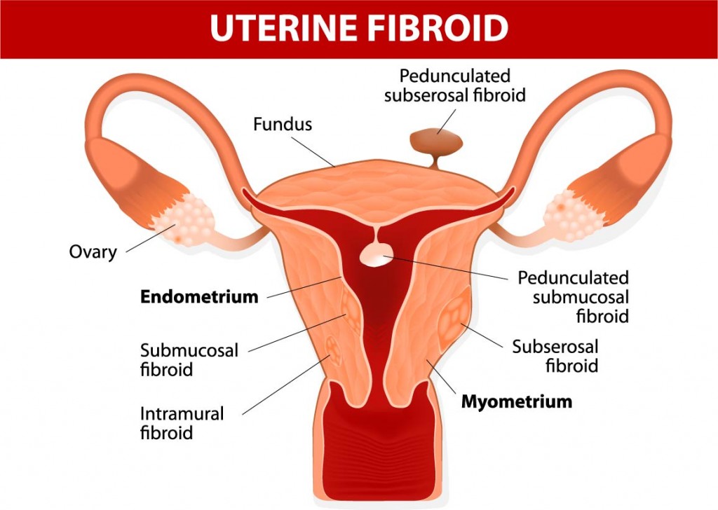 uterine-fibroids-1024x728.jpg