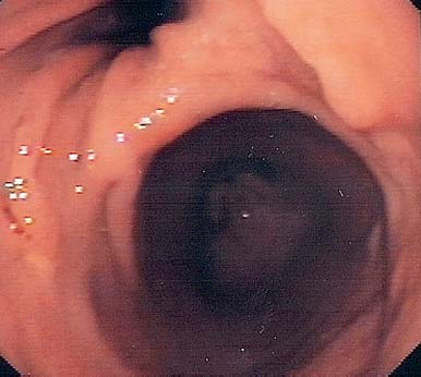 Endoscopic image of the normal gastric mucosa in retrovision