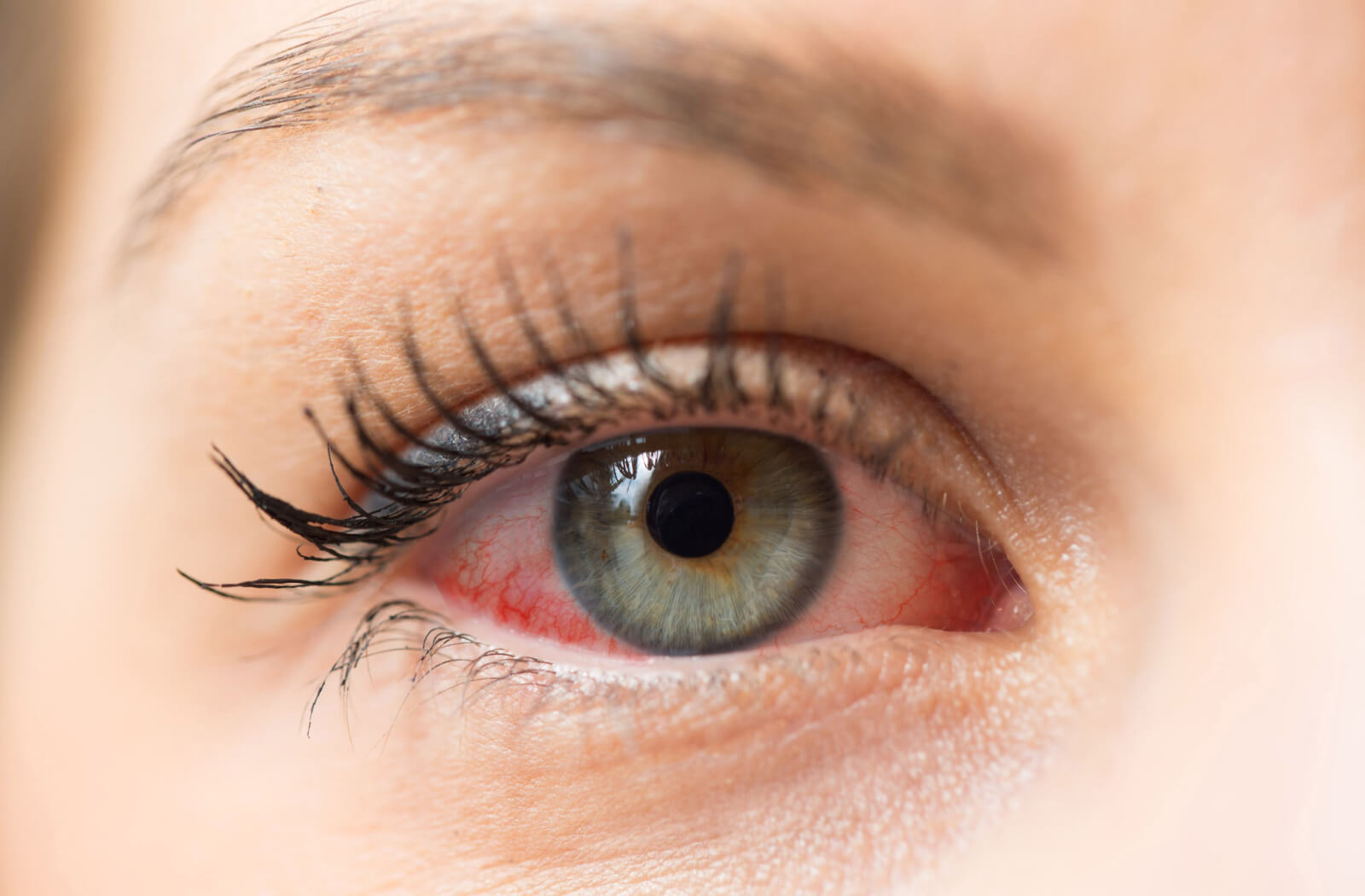a close up of a woman's eye, which is very red due to dry eye