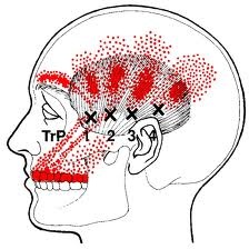 Temporalis