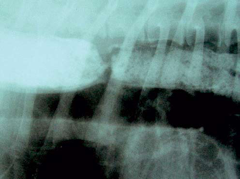 Radiograph with contrast medium that indicates esophageal stenosis
