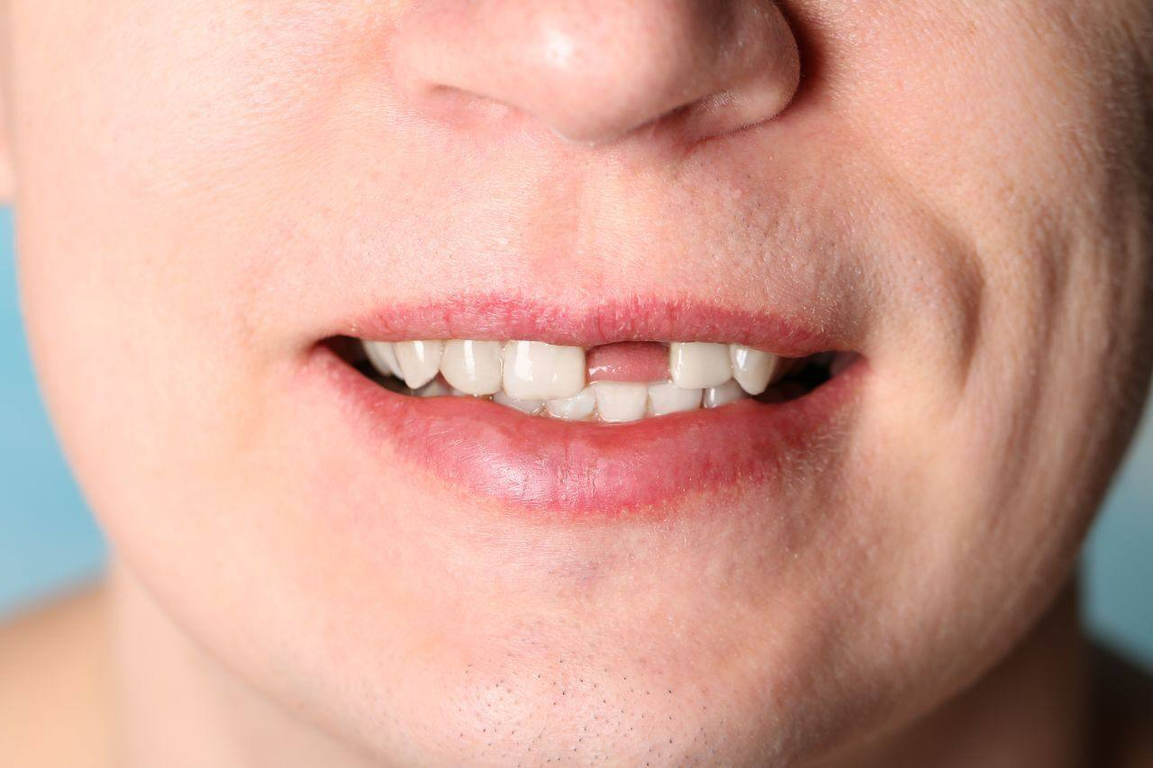 Почему выпал зуб у взрослого. Частичное отсутствие зубов. Отсутствие передних зубов. Отсутствуют передние зубы.