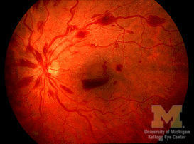 Neovascularization breaks through ILM (inner limiting membrane 