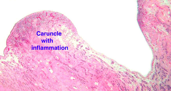 Endometrium of okapi with chronic endometritis, mostly confined to caruncle