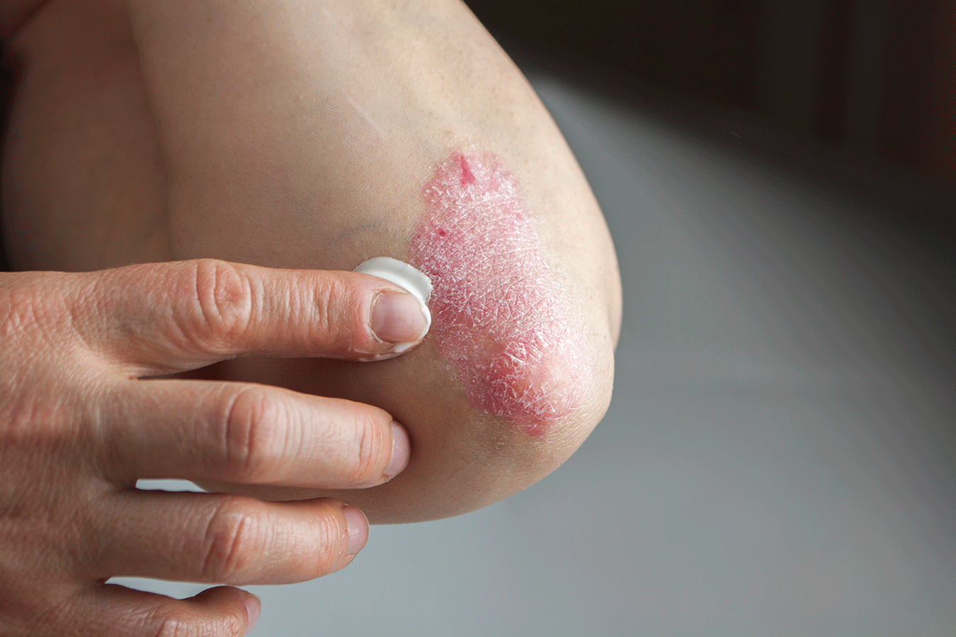 Psoriasis Treatment by Dr. Sachin Sharda