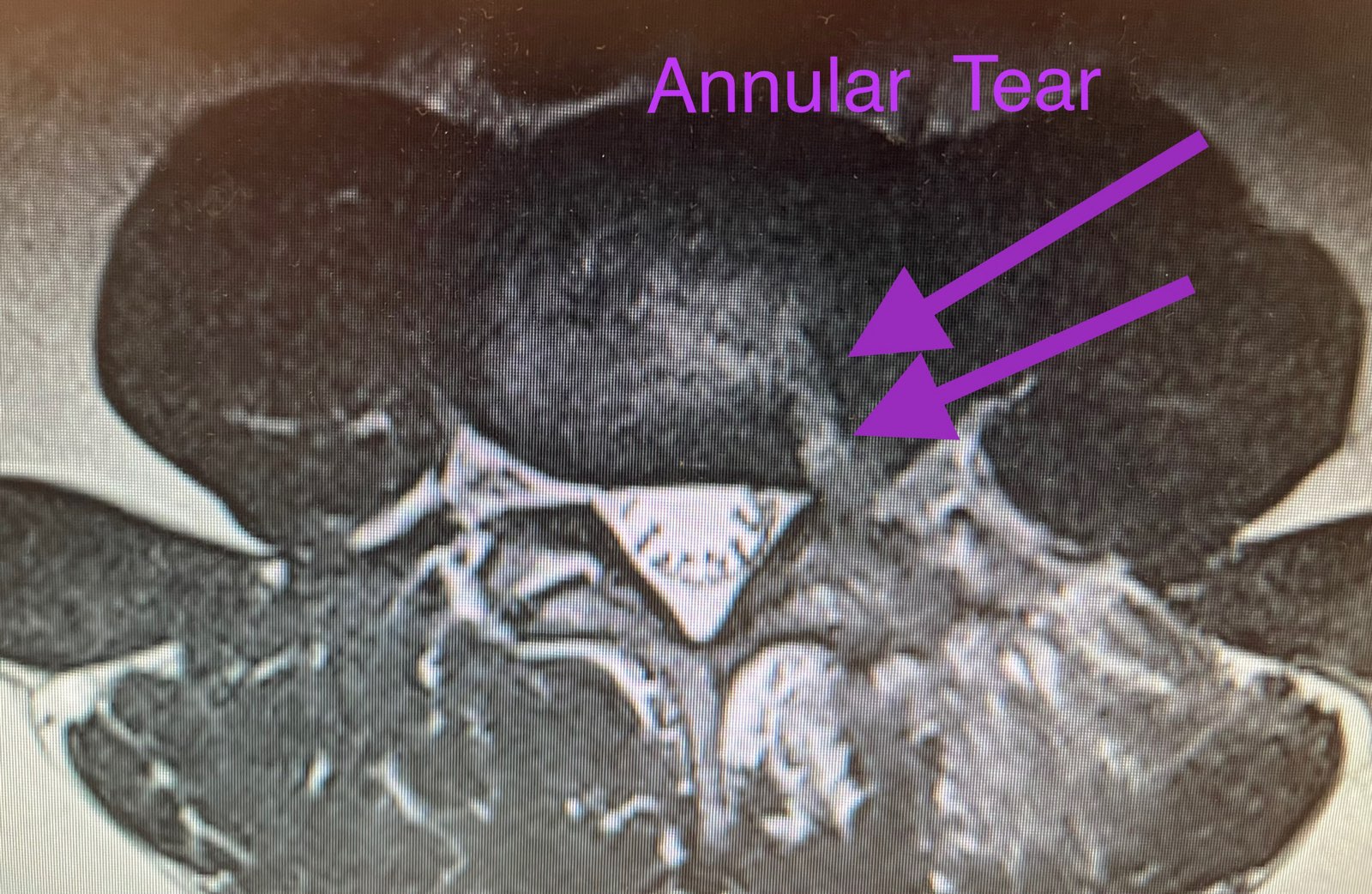 laser-spine-surgery-annular-tear