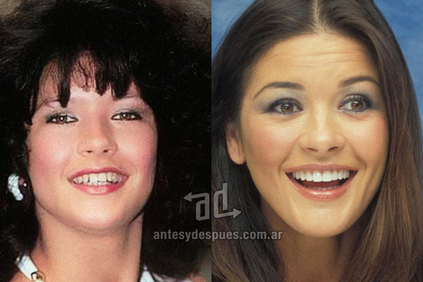 Catherine Zeta Jones y sus nuevos dientes, antes y despues